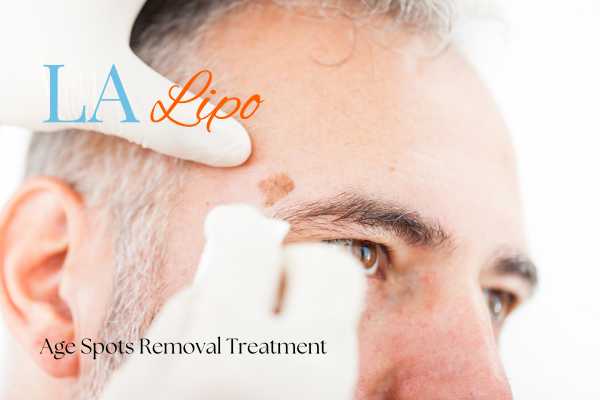 What Are the Most Effective Treatments for Age Spots Somerset?