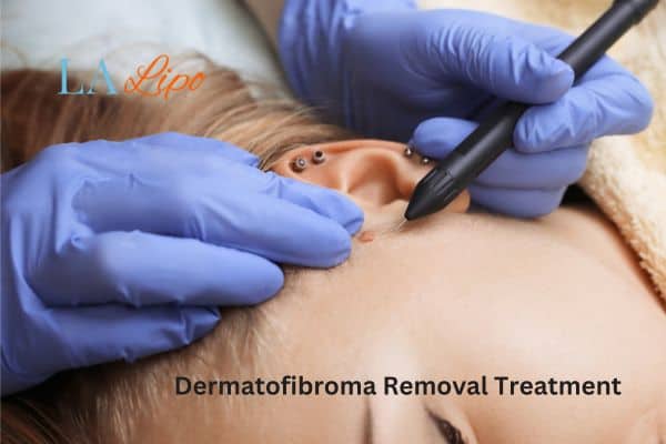 Dermatofibroma Removal Treatment Somerset
