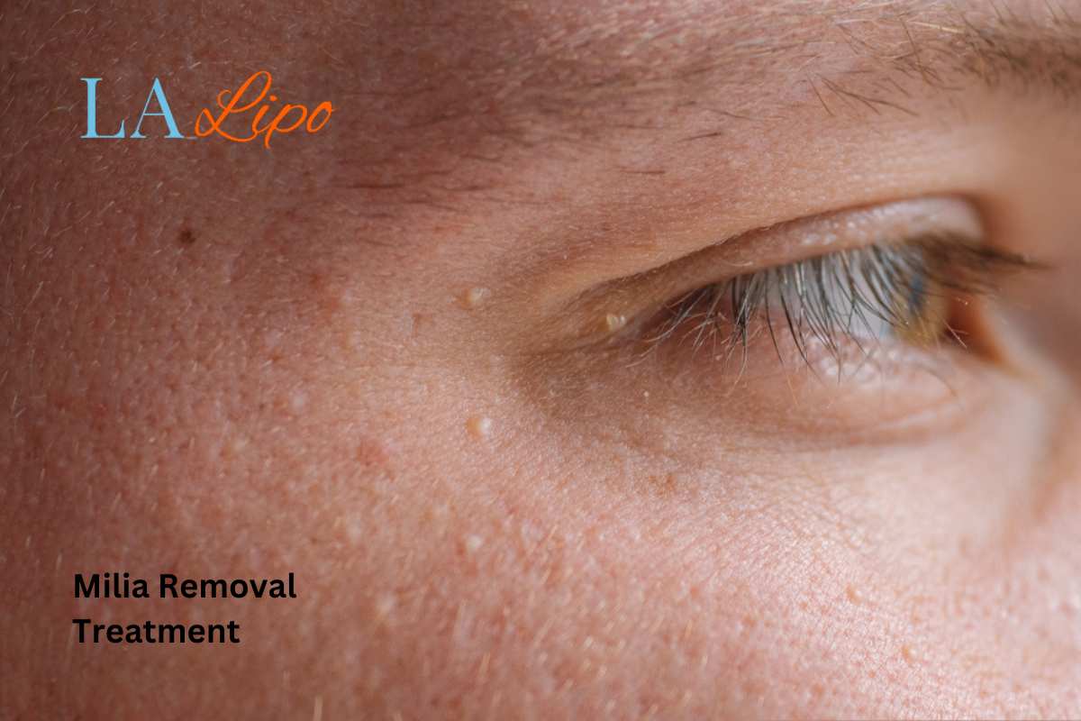 Cryopen Milia Removal: Is It the Easiest and Safest Option Somerset?