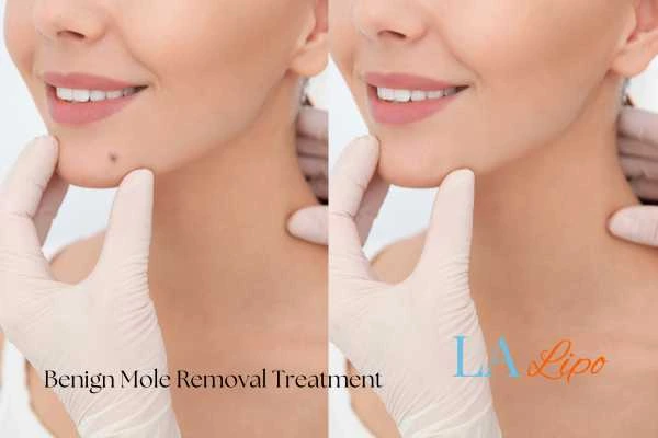 woman's before and after mole removal Somerset results