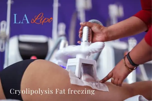 women getting fat freezing Somerset