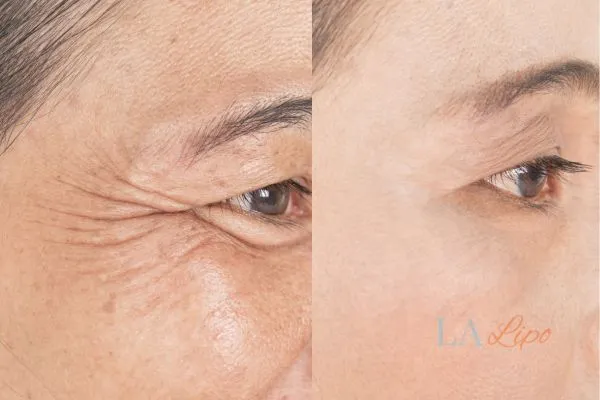 Before and after results of woman - HI-fu wrinkles reduction treatment Somerset