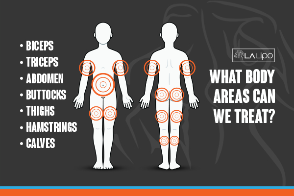 Graphic to show areas you can have LA-EMS Body Sculpting Somerset treatment.