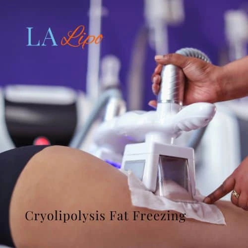 fat freezing - Cryolipolysis Somerset