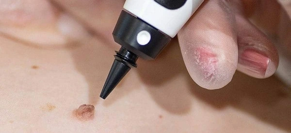 skin tag removal using cryopen Somerset