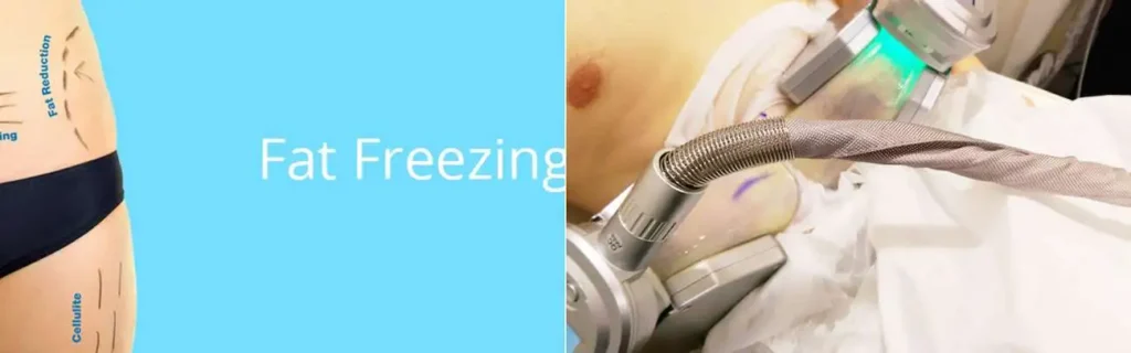 Fat freezing Somerset on multiple areas of the body