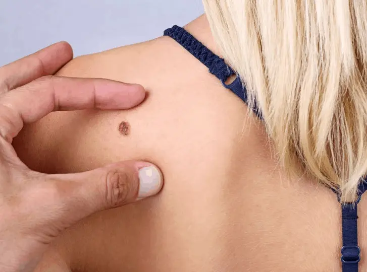 woman having mole removal Somerset consultation before treatment.