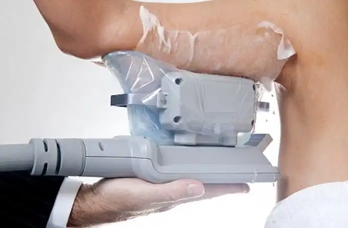 Picture of fat freezing Somerset on the upper arms.