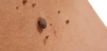 image of a skin tag Somerset