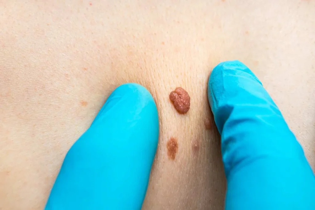 Consultant examining a skin tag Somerset