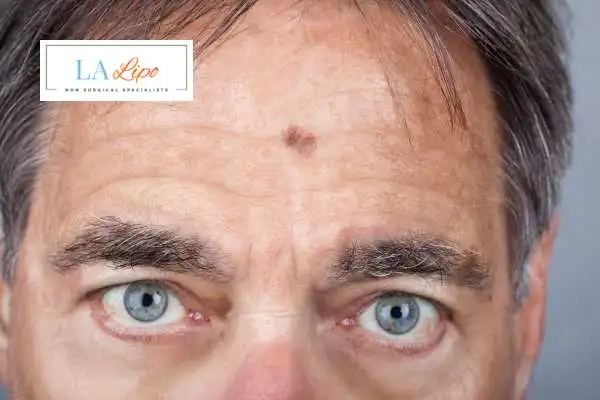 Solar Lentigo Removal Somerset image of man with mark on his forehead