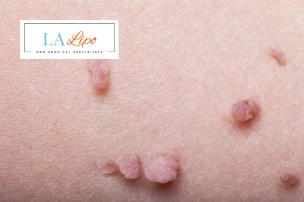 Does cryopen skin tag removal Somerset hurt? Find out now call our team today!