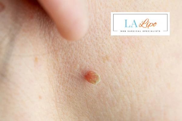 Book skin tag removal Somerset today speak to our team now!