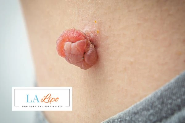 Interested in skin tag removal Somerset? Concerned about the pain? Find out more today!
