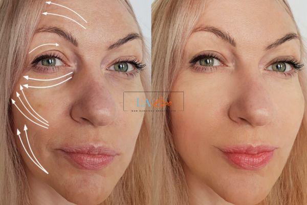 Morpheus 8 results Somerset face lift.