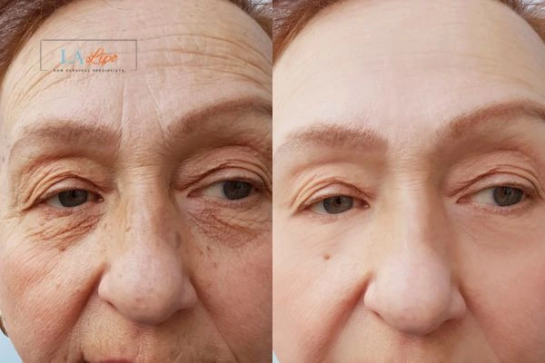 The powerful benefits of Morpheus8 Treatment Somerset - Call Our team today!