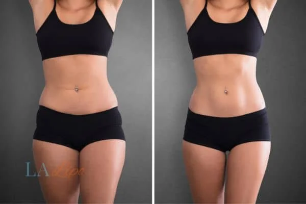 before and after results of non-surgical treatment to help a woman's body image and mental health Somerset