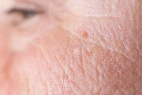 close up picture of a woman's face showing an age spot Somerset