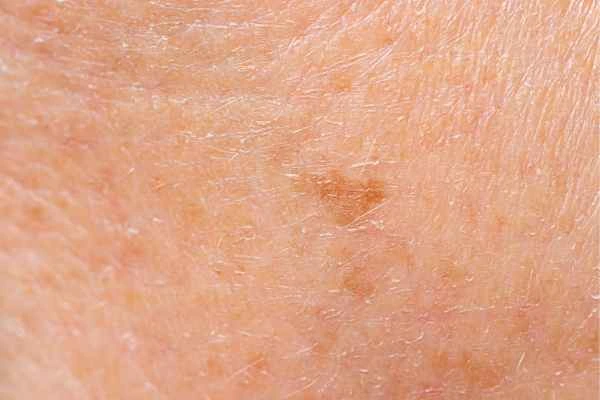 close up picture of age spots Somerset