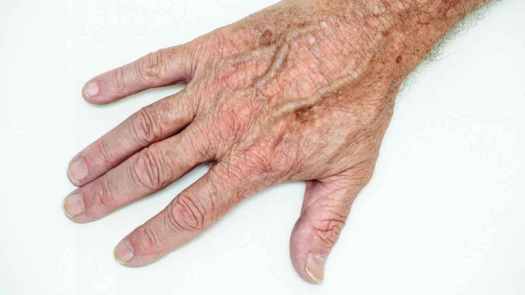 Male hand showing age spot Somerset