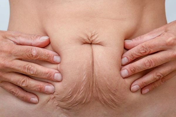 Image of a woman's stomach with loose skin - example of skin tightening Somerset options